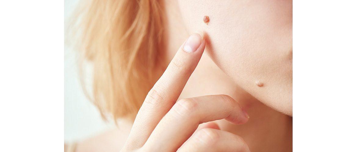 picture mole woman face plastic surgery sheffield morritt cosmetic