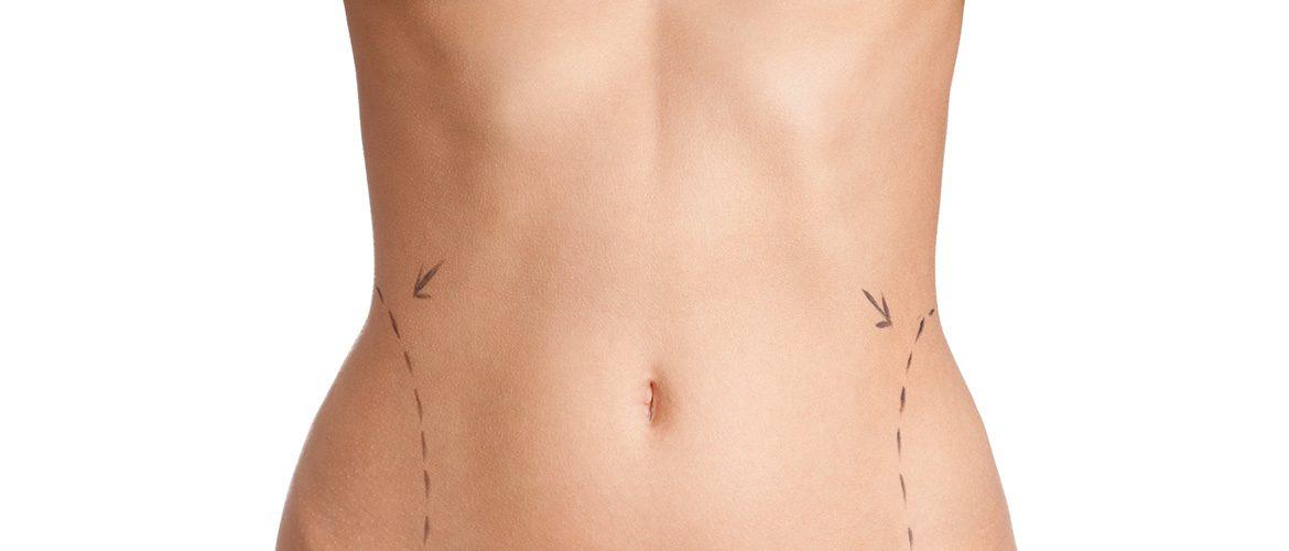 image tummy tuck abdominoplasty plastic surgery cosmetic surgery sheffield