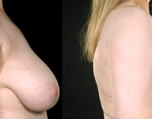 Breast reduction photos before after surgery Sheffield Mr Morritt Plastic Surgeon