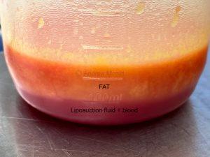 picture showing fat harvested using liposuction