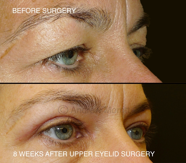upper blepharoplasty eyelid lift surgery Sheffield 