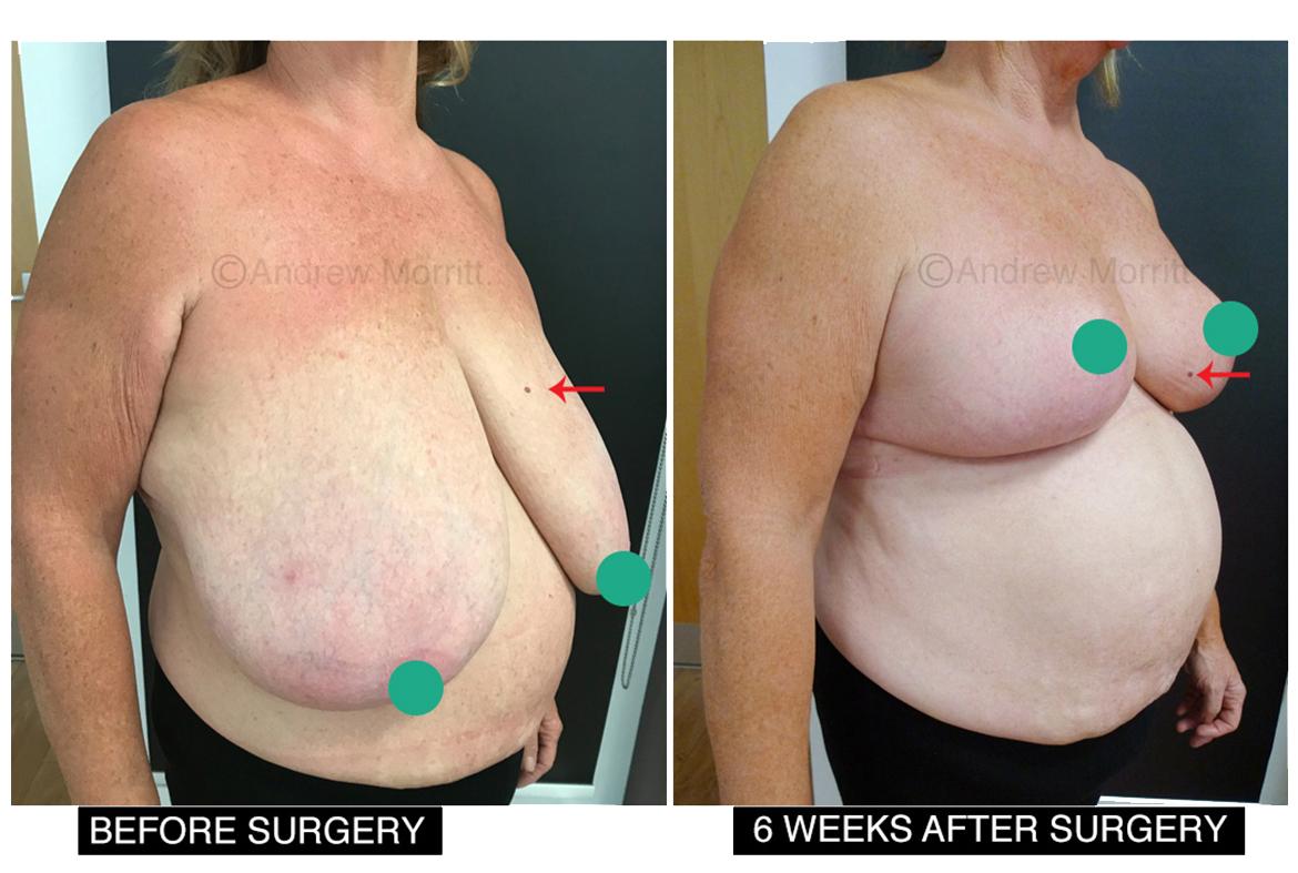 breast reduction surgery gigantomastia