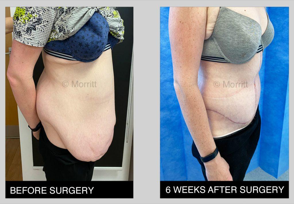 appearances before after tummy tuck