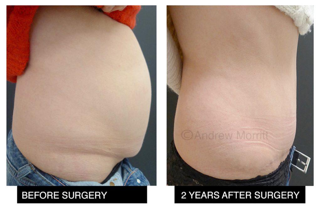 appearances before and after tummy tuck