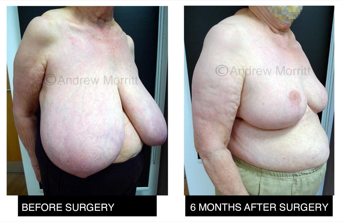 breast reduction surgery