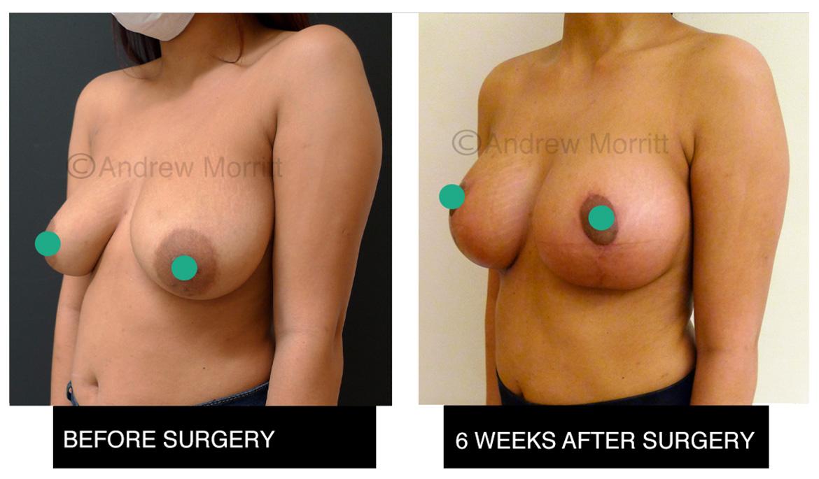 before and after photos of patient breast augmentation breast uplift Mr Morritt Sheffield