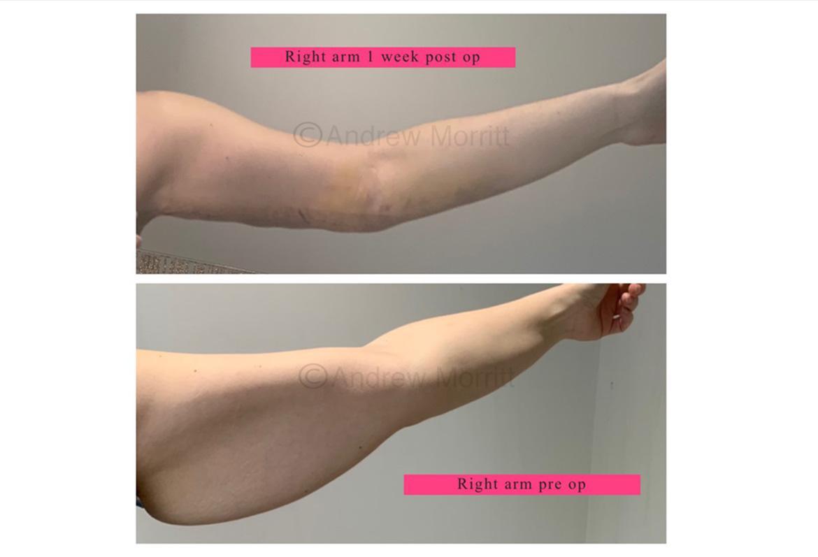 photos before and after arm reduction brachioplasty