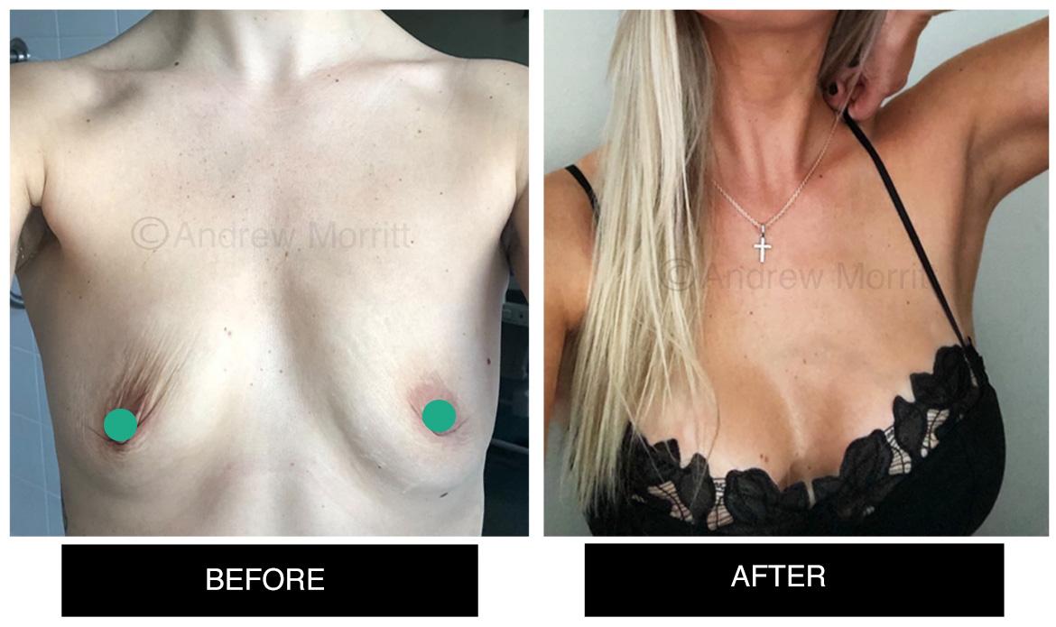 breast augmentation