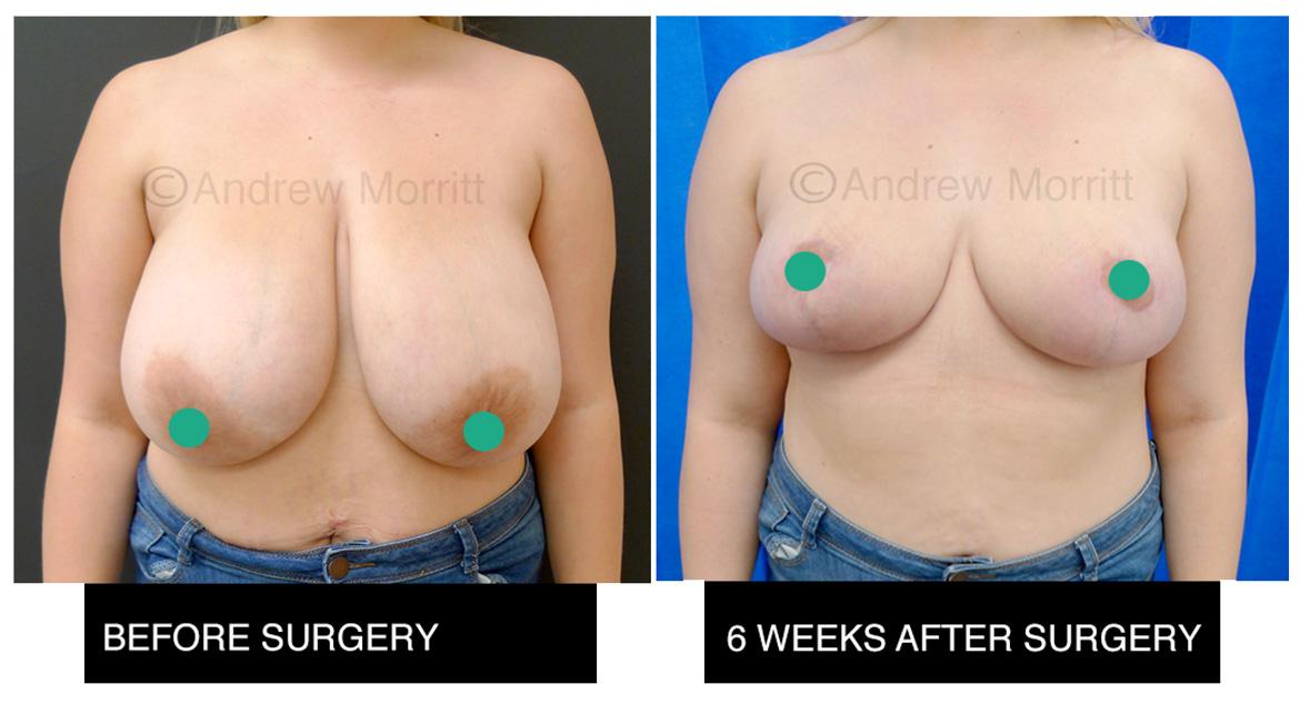 breast reduction