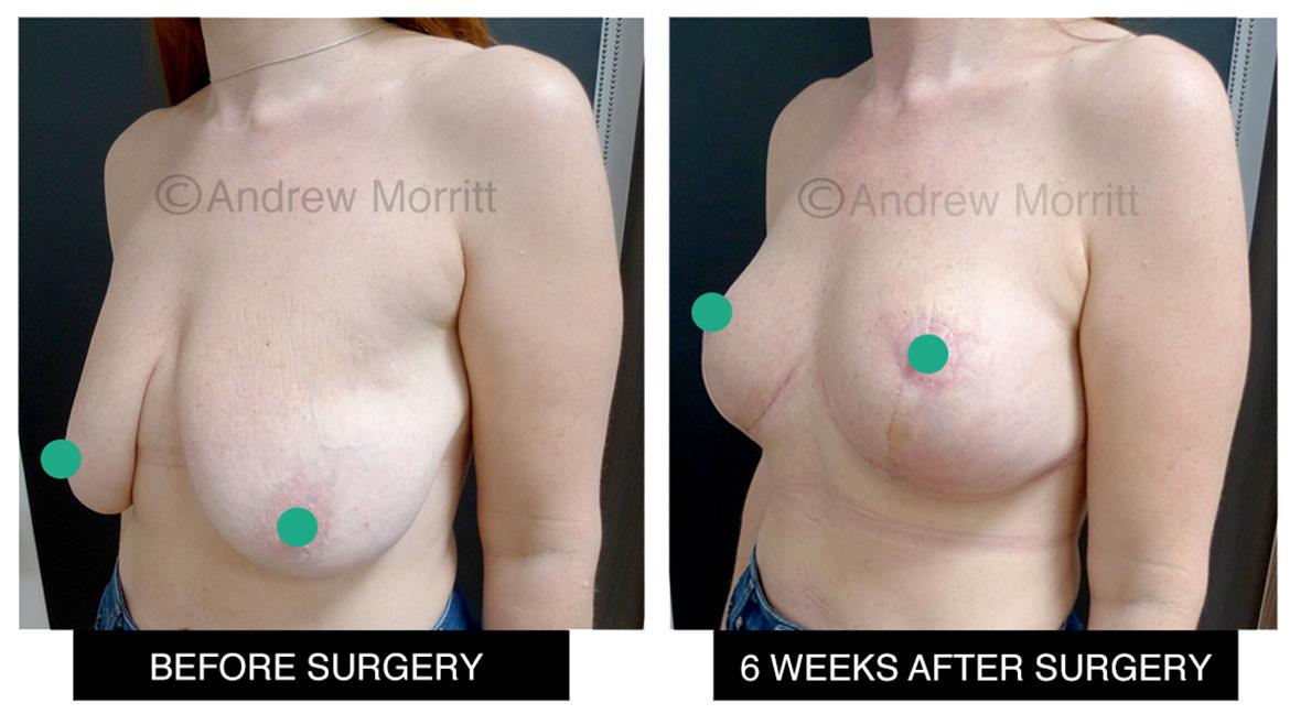photos showing before and after appearance breast uplift mastopexy surgery Sheffield