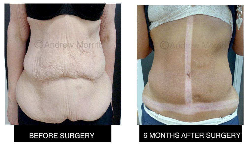 appearance before and after fleur de lys tummy tuck