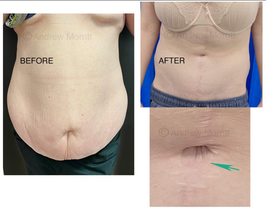 appearances before and after fleur de lys tummy tuck