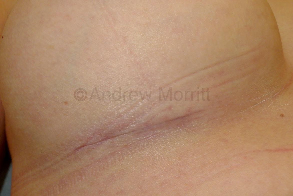 breast augmentation scar