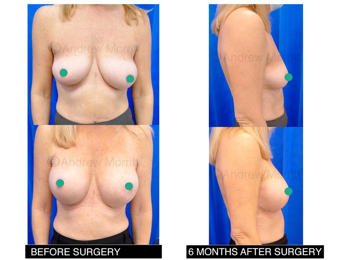 breast augmentation