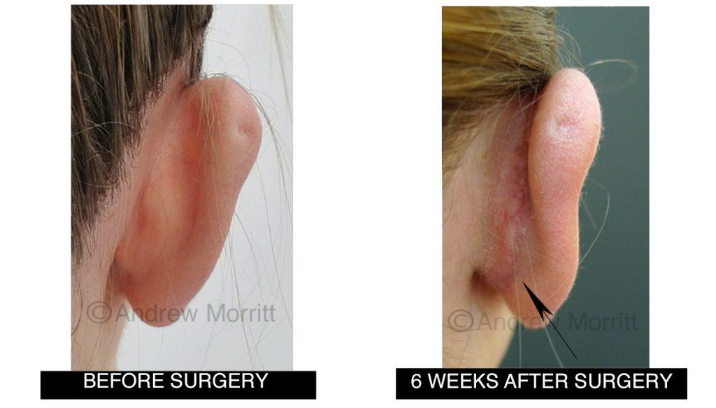 before and after prominent ear correction surgery mr morritt sheffield