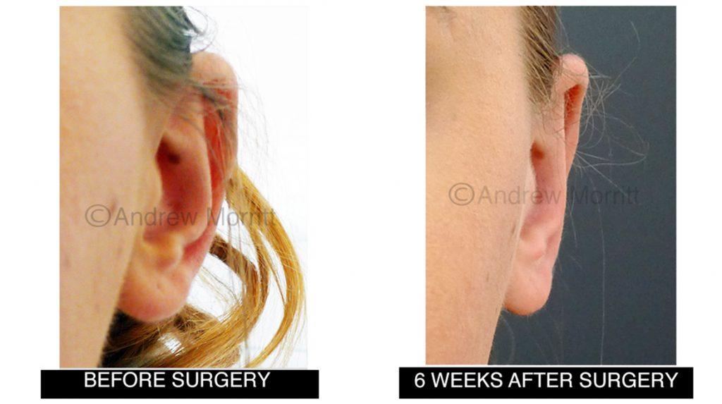 before and after photos prominent ear surgery sheffield mr morritt