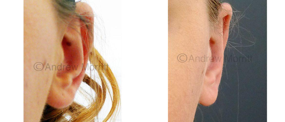 prominent ear correction before after sheffield