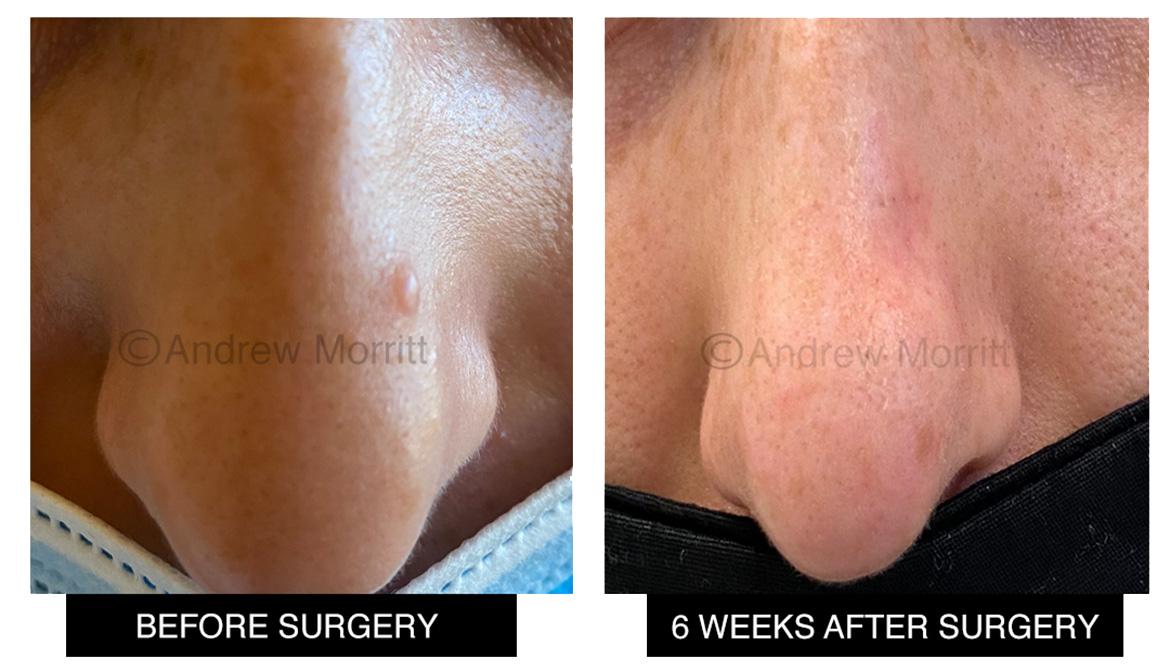before and after photos showing appearances of mole removal surgery mr morritt sheffield