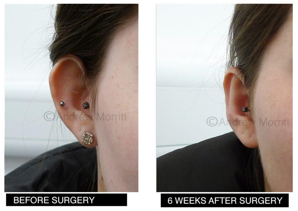 prominent ear correction before after sheffield