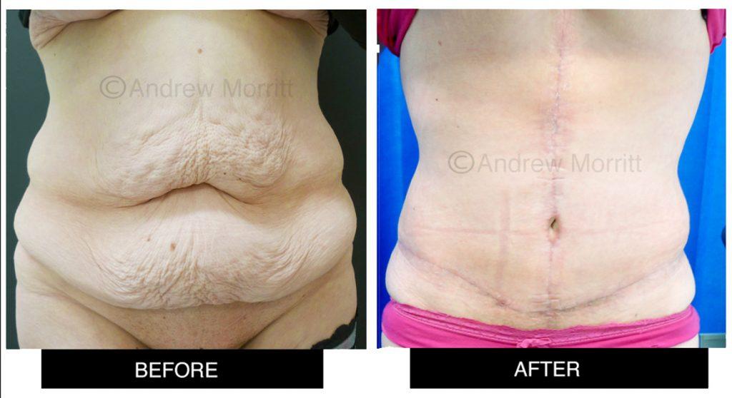 appearance before and after tummy tuck abdominoplasty