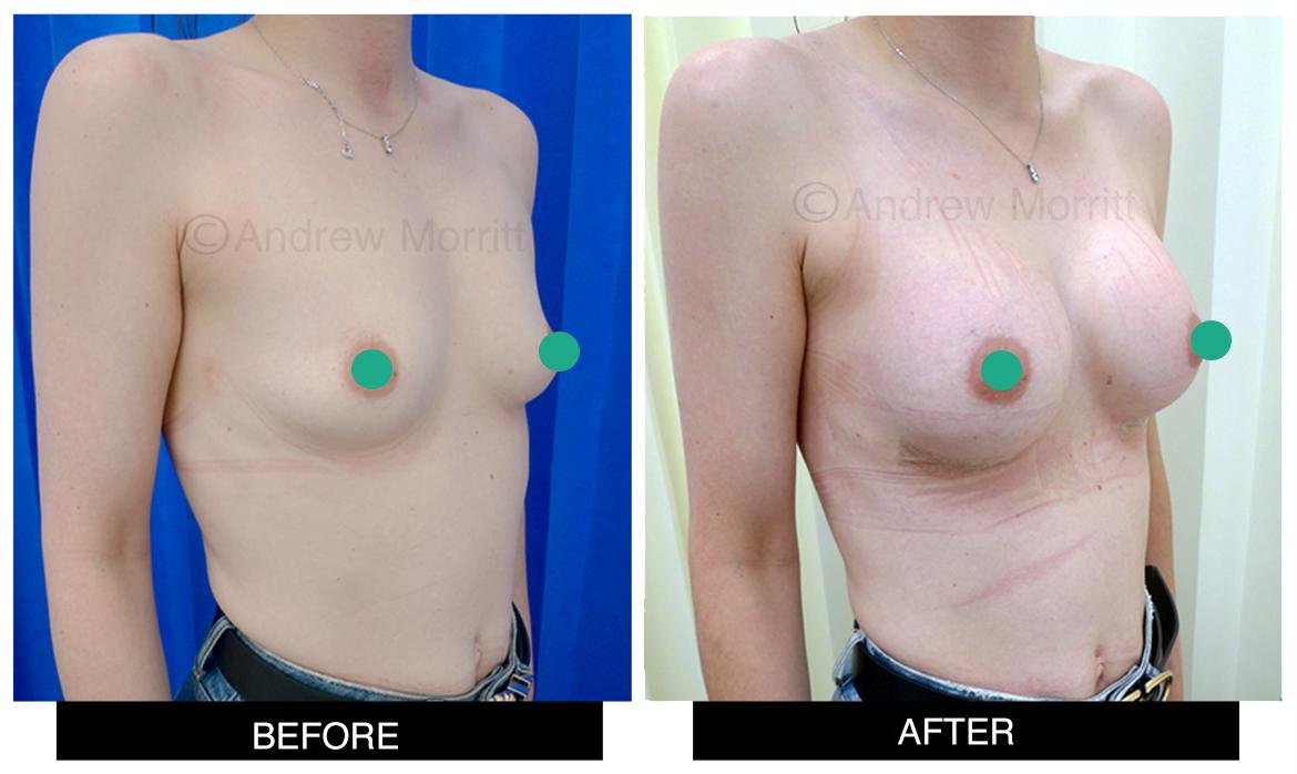 breast augmentation