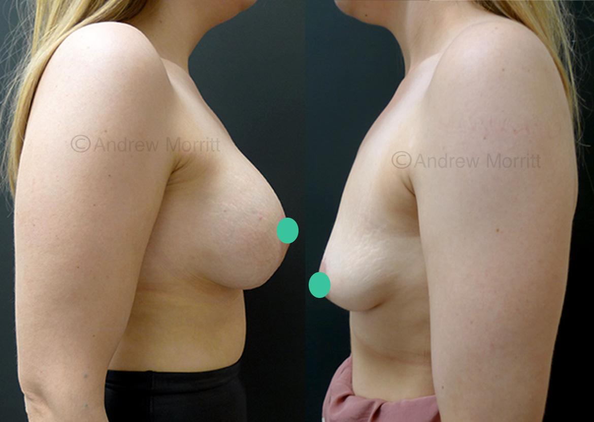 breast augmentation and uplift mastopexy augmentation sheffield