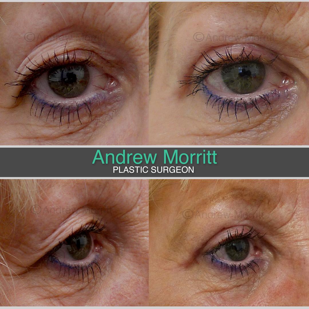 upper blepharoplasty eyelid surgery sheffield