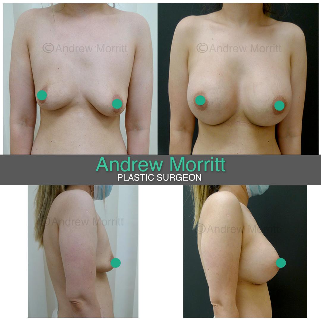 breast implant surgery