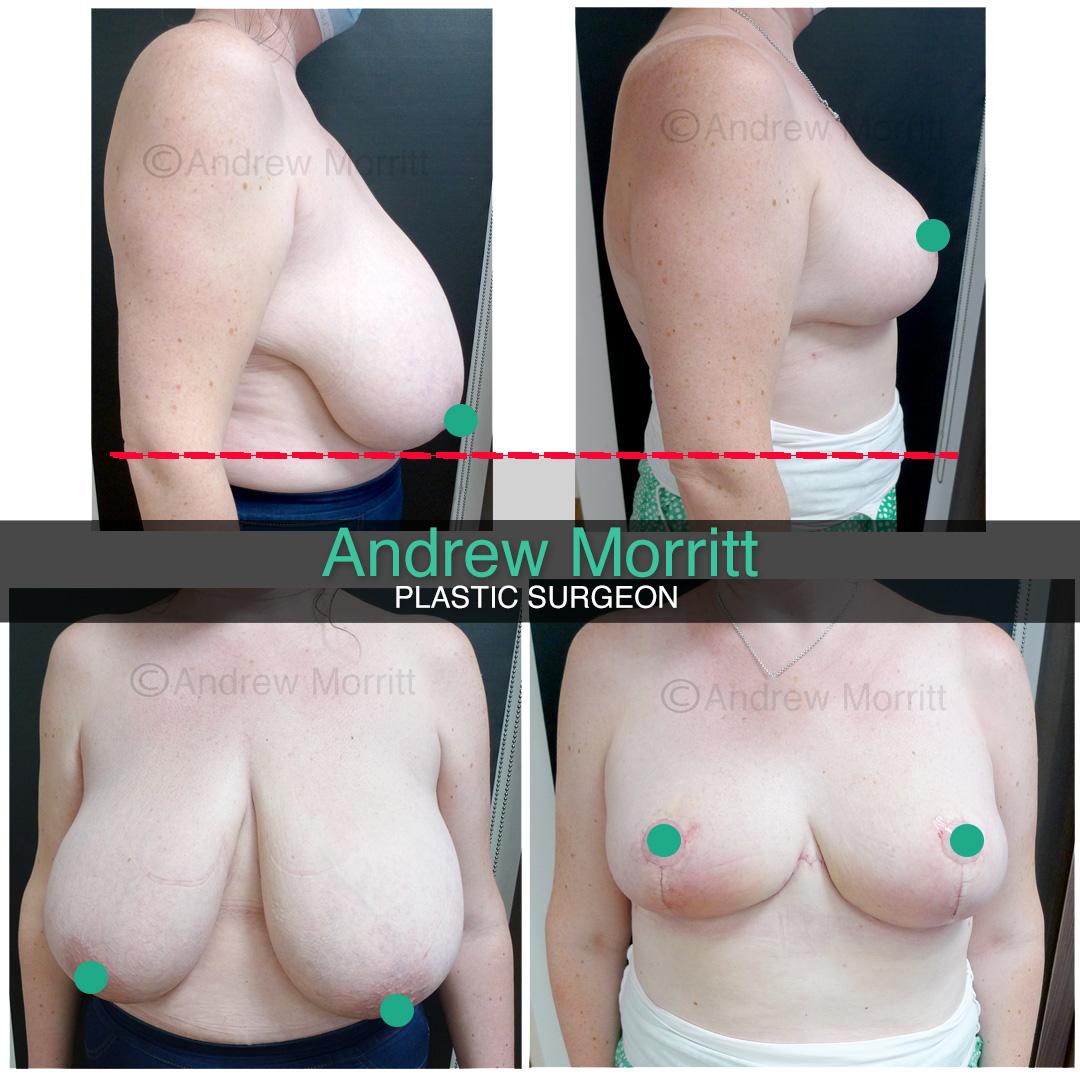 breast reduction