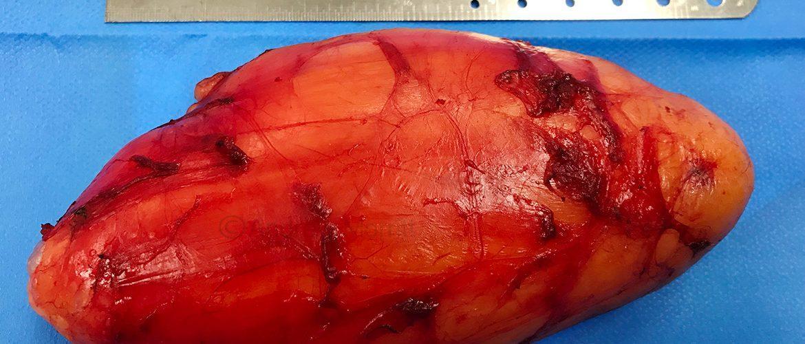 photo lipoma ALT removal sheffield