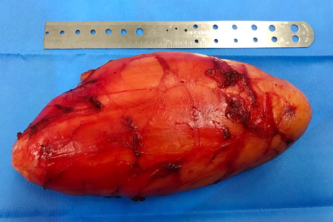 photo lipoma ALT removal sheffield