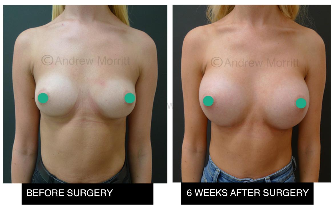 breast augmentation