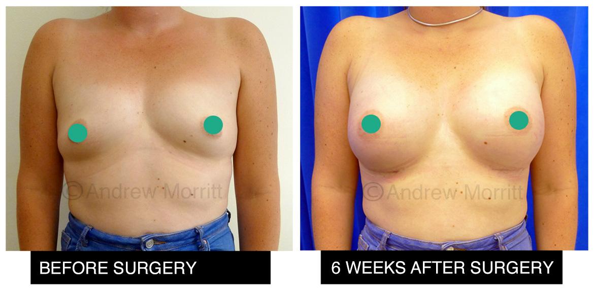 breast augmentation