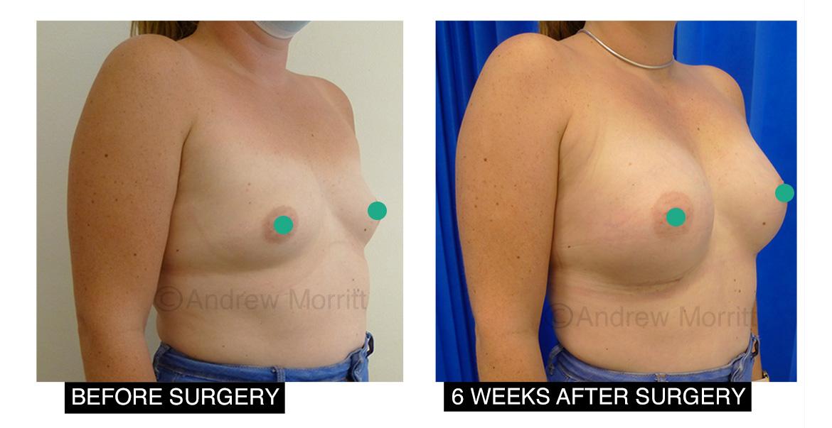 breast augmentation