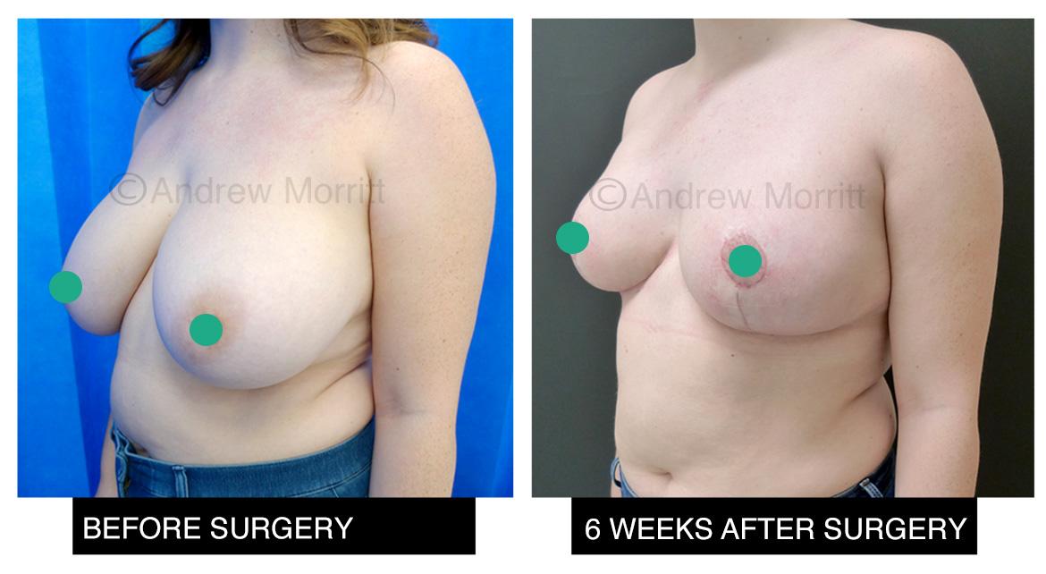 breast reduction