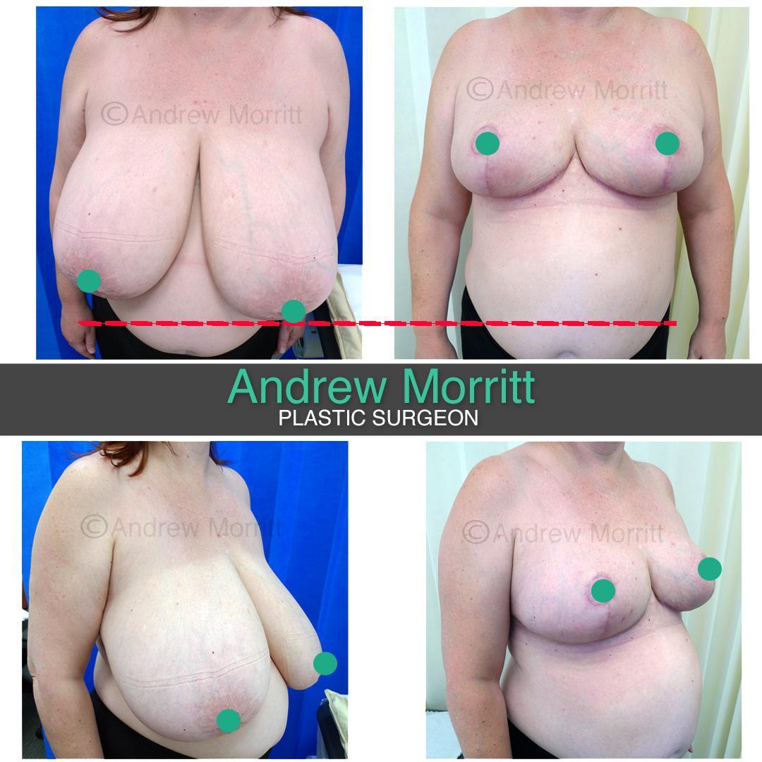 breast reduction