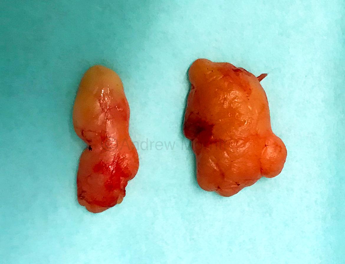 photo lipoma removal dercum's disease sheffield