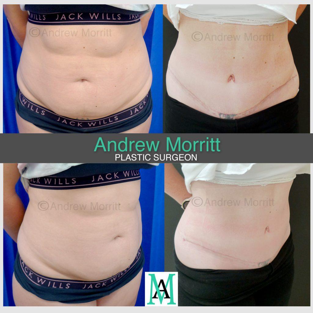appearances before and after tummy tuck