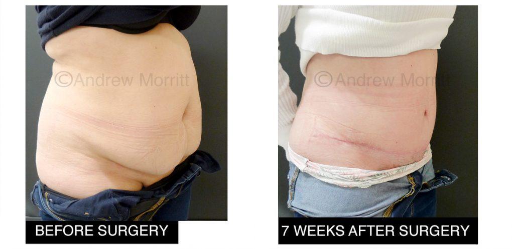 appearances before and after lipoabdominoplasty
