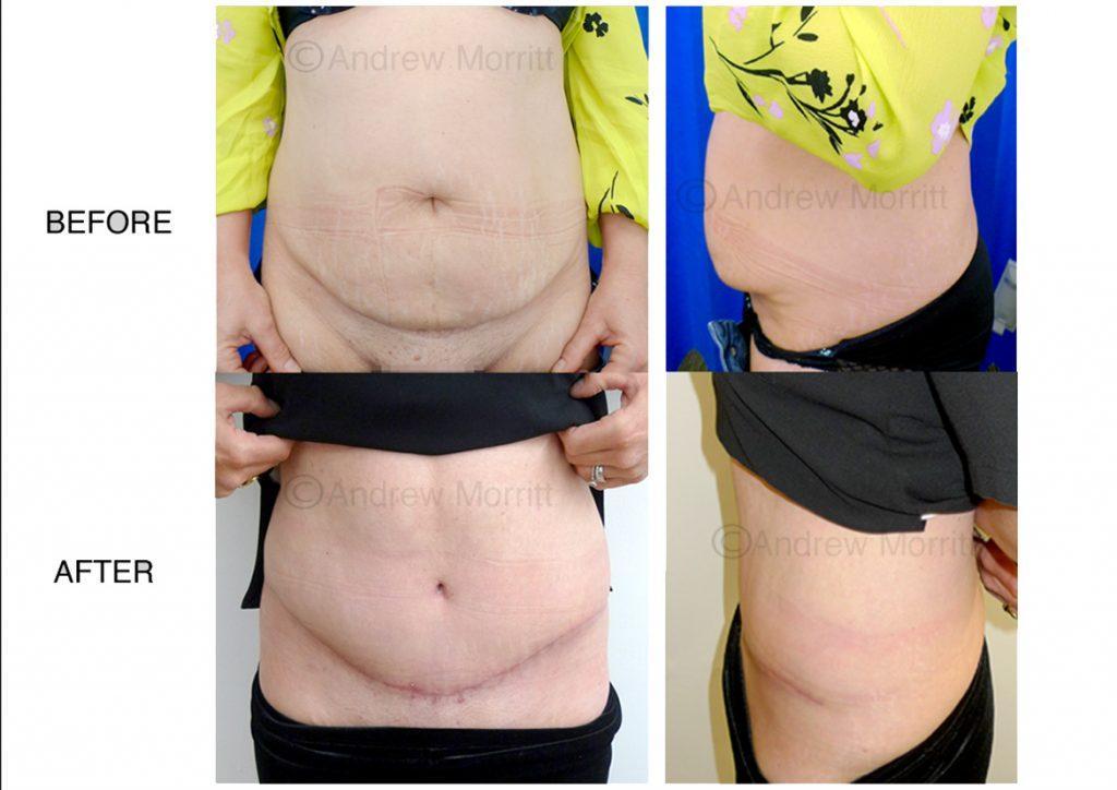 appearance before and after tummy tuck