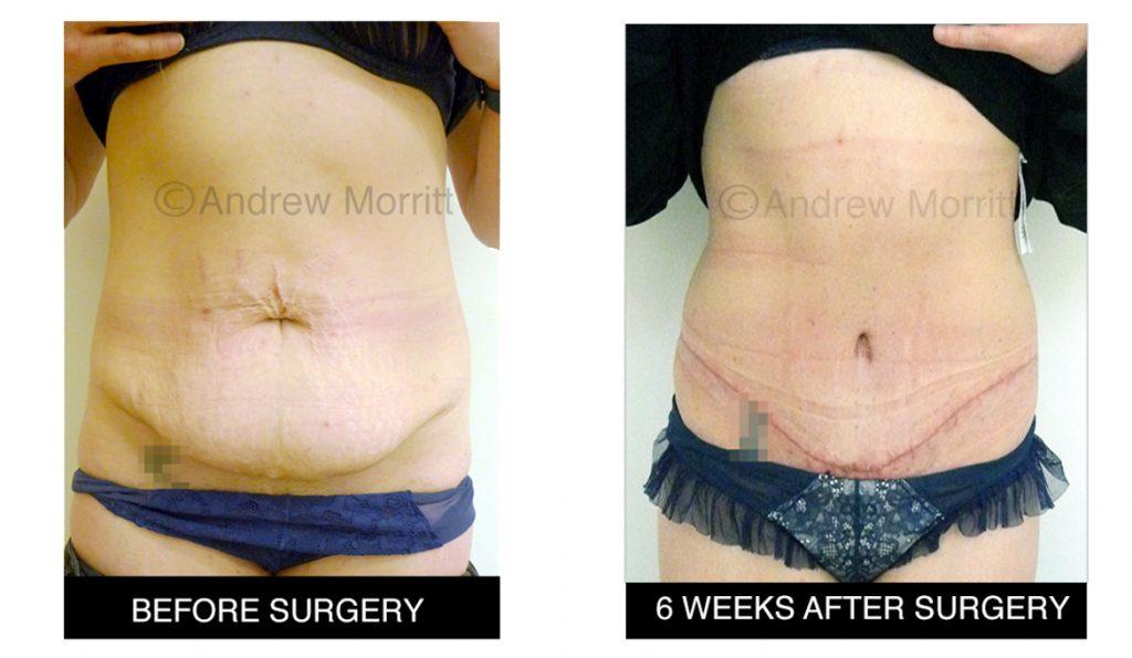 appearance before and after tummy tuck