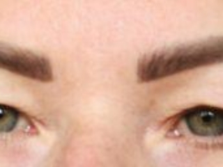 Photo showing appearances before upper blepharoplasty eyelid surgery