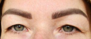 Before upper blepharoplasty eyelid surgery Photo showing appearances before upper blepharoplasty eyelid surgery