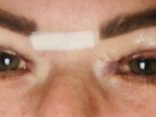 Photos showing appearances 1 day after upper blepharoplasty eyelid surgery