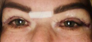 Appearances 1 day after upper blepharoplasty eyelid surgery Photos showing appearances 1 day after upper blepharoplasty eyelid surgery