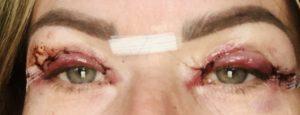 Appearances 2 days after upper blepharoplasty eyelid surgery Photos showing appearances 2 days after upper blepharoplasty eyelid surgery