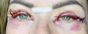 Appearances 3 days after upper blepharoplasty eyelid surgery Photos showing appearances 3 days after upper blepharoplasty eyelid surgery