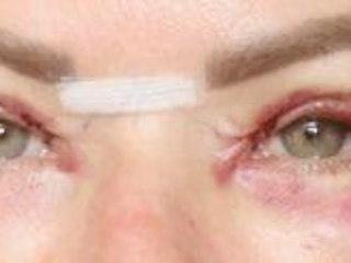 Photos showing appearances 4 days after upper blepharoplasty eyelid surgery