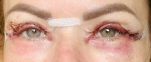 Appearances 4 days after upper blepharoplasty eyelid surgery Photos showing appearances 4 days after upper blepharoplasty eyelid surgery