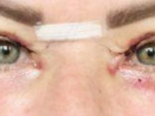Photos showing appearances 5 days after upper blepharoplasty eyelid surgery